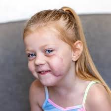 Mum of girl bitten by dog calls for XL Bully ban or 'someone is going to  die'