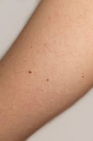 Keratosis pilaris is sometimes referred to as chicken skincredit: 8 Common Skin Problems And How To Fix Them Acne And Rosacea Advice