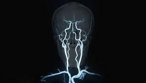 Cerebral (brain) aneurysms occasionally cause some of these symptoms as they start to swell ultrasound, magnetic resonance imaging (mri), and computed tomography (ct) scans can all. Brain Aneurysm 4 Things You Need To Know Johns Hopkins Medicine