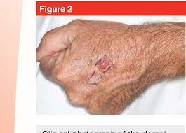 Images psoriasis hand unpredictable and irritating, psoriasis is one of the most baffling and persistent of skin disorders. Figure 2 From Skin Cancer Of The Hand Current Concepts Semantic Scholar