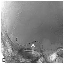 A computed tomography (ct or cat) scan allows doctors to see inside your body. Asnr Neuroradiology Patient Info