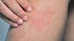 Lo schema che segue indica in ordine alfabetico gli alimenti da evitare perché contengono nichel o potrebbero averne in parte. Allergia Al Nichel A Cosa Bisogna Fare Attenzione Luccaindiretta