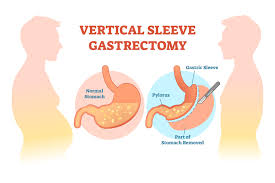 lose weight fast with gastric sleeve
