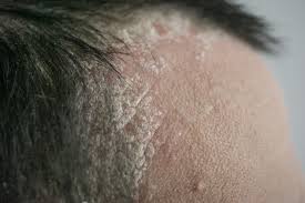 Dandruff is recognizable by visible flakes that can be seen on the hair and shoulders and can be easily treated with the rightshampoo. Psoriasis Or Dandruff Symptoms Treatment And Tips