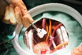 Prosthesis Patient Mismatch After Aortic Valve Replacement Declining But Tied To Poorer Survival Tctmd Com