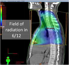 Krankheitsschübe wie auch läsionen in der magnetresonanztomographie (mrt) reflektieren den krankheitsprozess bei der… teriflunomid reduziert den jährlichen verlust an hirnvolumen frankfurt, 02. Localised Multiple Sclerosis Like Disease After Irradiation Of The Cervicothoracic Spinal Cord Multiple Sclerosis And Related Disorders