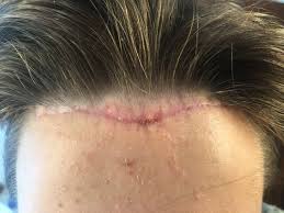 , i did surgery three times and it still didn't help. Forehead Reduction Surgery Scar Progress And Hair Loss Photo