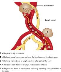 Metastasis Via Lymph System Cancer Resources Cancer Knowledge Radiation Therapy
