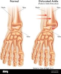 Image result for Ankle Dislocation