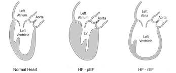 understanding heart failure cleveland clinic