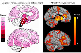 The patient has tremor, rigidity, slowness and paucity of movement, or poor condition in the arm and/or legs on one side of the body. New Study Maps The Progression Of Parkinson S Disease Within The Brain The Neuro Mcgill University