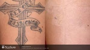 Whilst you may be getting excited about having your treatment with us here at inkden tattoo and laser removal clinic blackpool, the process after your laser. Laser Tattoo Removal Aftercare And Faq Picosure Laser Tattoo Removal Chicago