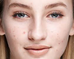 Different Types Of Skin Blemishes Skin Imperfections