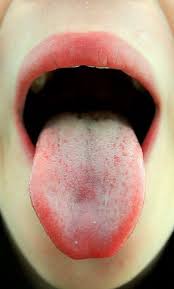How To Tell If You Are A Supertaster Burning Mouth Syndrome Mouth Sores Home Remedies For Thrush