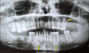 There have been a few families reported that have had more than one family member with fcod. Jomr Co Occurence Of Florid Cemento Osseous Dysplasia And Simple Bone Cyst A Case Report