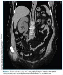 Image result for Nephrolithiasis Imaging