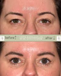 ✨ Blinking into a new era ✨ 👁️ Upper bleph glow-up! 📍 Before ➡️ After ➕  Confidence 🎯 Bags packed (and removed) Let's talk glow up era! Give us a  call for