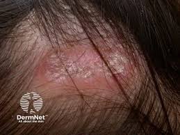 Image result for dry scabs on the head in children