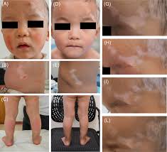 A–C) Scaly red patches