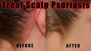 How To Treat Scalp Psoriasis 5 Natural Ways For Treating Psoriasis Of The Scalp At Home Youtu Scalp Psoriasis Treatment Scalp Psoriasis Psoriasis Treatment