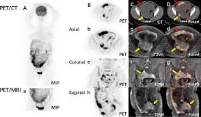 Added value of regional 18F-FDG PET/MRI-assisted whole-body 18F-FDG PET/CT  in malignant ascites with unknown primary origin
