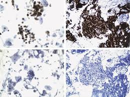Young people with weakened immune systems can also develop merkel cell carcinoma. Ttf 1 And P63 For Distinguishing Pulmonary Small Cell Carcinoma From Poorly Differentiated Squamous Cell Carcinoma In Previously Pap Stained Cytologic Material Modern Pathology