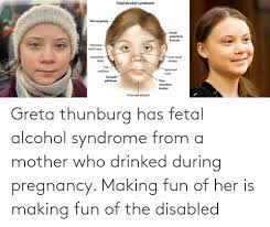 In asians it is normal, but in caucasians it may indicate an underlying syndrome. Fetal Alcohol Syndrome Microcephaly Small Palpebral Fissures Railroad Track Ears Epicanthal Folds Low Nasal Bridge Flat Midface Upturned Nose Smooth Philtrum Thin Vermilion Border Underdeveloped Greta Thunburg Has Fetal Alcohol Syndrome From