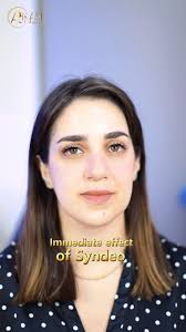 لحظات بتفصل بينك وبين بشرة ولا احلى، بأحدث تكنولوجيا لعلاج البشرة على مستوى  العالم بجهاز SYNDEO., لحجز المواعيد , +962777766609, +96264646609, 📌  الأردن- عمان- قرب الدوار الرابع، مجمع Vitro 2