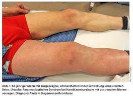 Tiefe Beinvenenthrombose Konservative Therapie Doctors Today