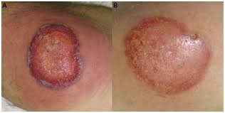 Image result for Pyoderma Gangrenosum