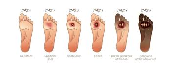 Image result for toe black diabetes