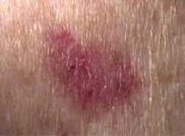 Detecting skin cancer early is the best way to ensure it is treated successfully. What Does Skin Cancer Look Like U S Dermatology Partners Blog