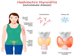 Image result for Goiter