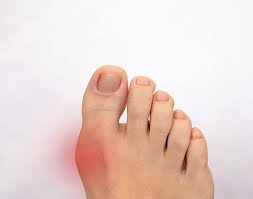 Image result for gout symptoms toe