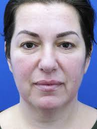Upper Skin Only Blepharoplasty 2657