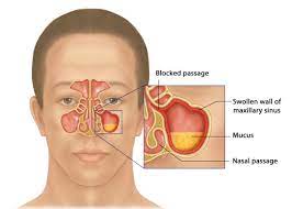 Chronic Rhinosinusitis Nasal Polyps Melbourne Ent Group