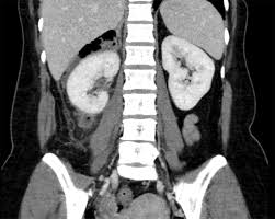 Image result for Perinephric Abscess