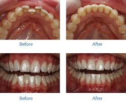 See full list on wikihow.com Inman Aligner Teeth Straightening Adult Braces Harrow Weald Whitestar Dental Practice