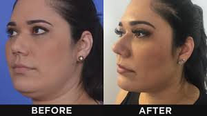 What do patients have to say? Melt Neck Fat Without Serious Surgery The Doctors Tv Show