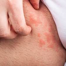 Image result for sore skin in the groin area
