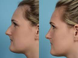 The types of rhinoplasty procedures include; Rhinoplasty Specialist Surgeons Otolaryngology A Nose Job