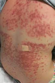 He may diagnose the disease with or without performing medical biopsy. Photo Induced Stevens Johnson Syndrome Journal Of The American Academy Of Dermatology