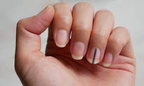 What does cancer look like? Stripe Under Fingernails Could Be Sign Of Cancer Doctor Warns