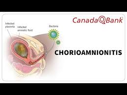 Image result for Chorioamnionitis