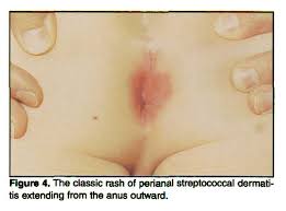 Significados de branny desquamation en diccionario español inglés : Pediatric Dermatoses Commonly Seen Uncommonly Recognized Pediatric Annals
