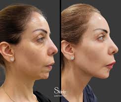 Non-Surgical Facelift NYC