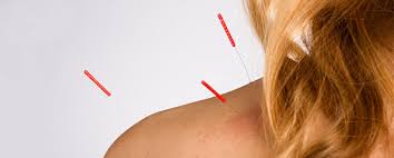 Akupunktur Ile Boyun Fitigi Tedavisi Dr Ebru Akupunktur Resmi Web Sitesine Hosgeldiniz