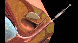 Image result for Chorionic Villus Sampling