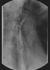 A recent review reveals 56 documented cases in the literature. Candida Esophagitis Radiology Case Radiopaedia Org