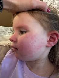 What rowe casa products help atopic dermatitis?